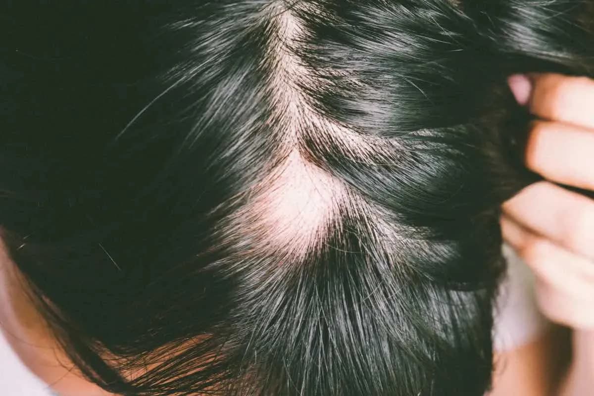 Imagem ilustrativa: alopecia areata